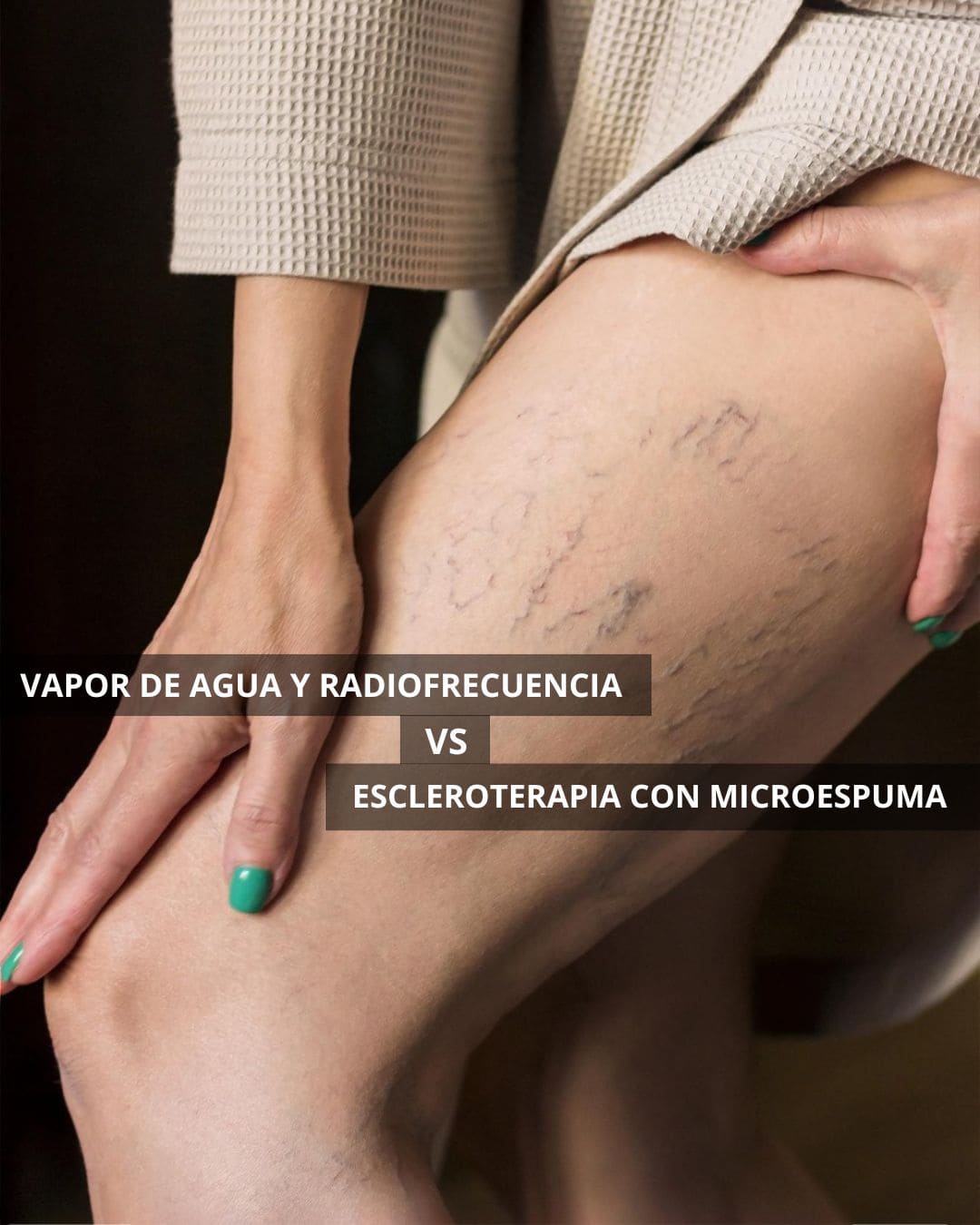 Vapor de Agua y Radiofrecuencia vs. Escleroterapia con Microespuma