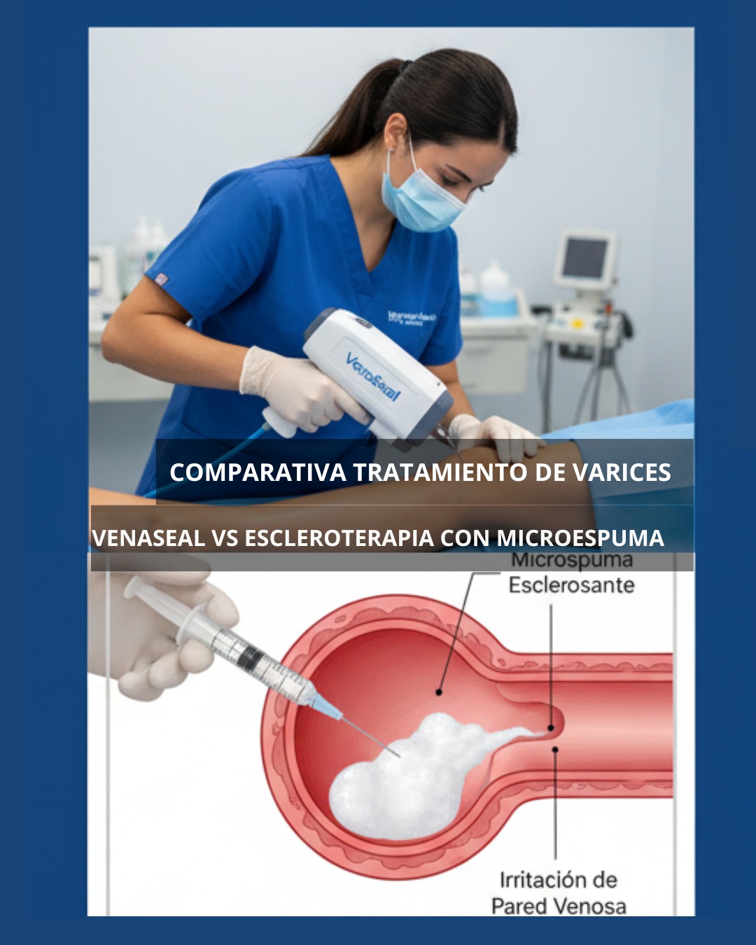 Venaseal vs. Microespuma
