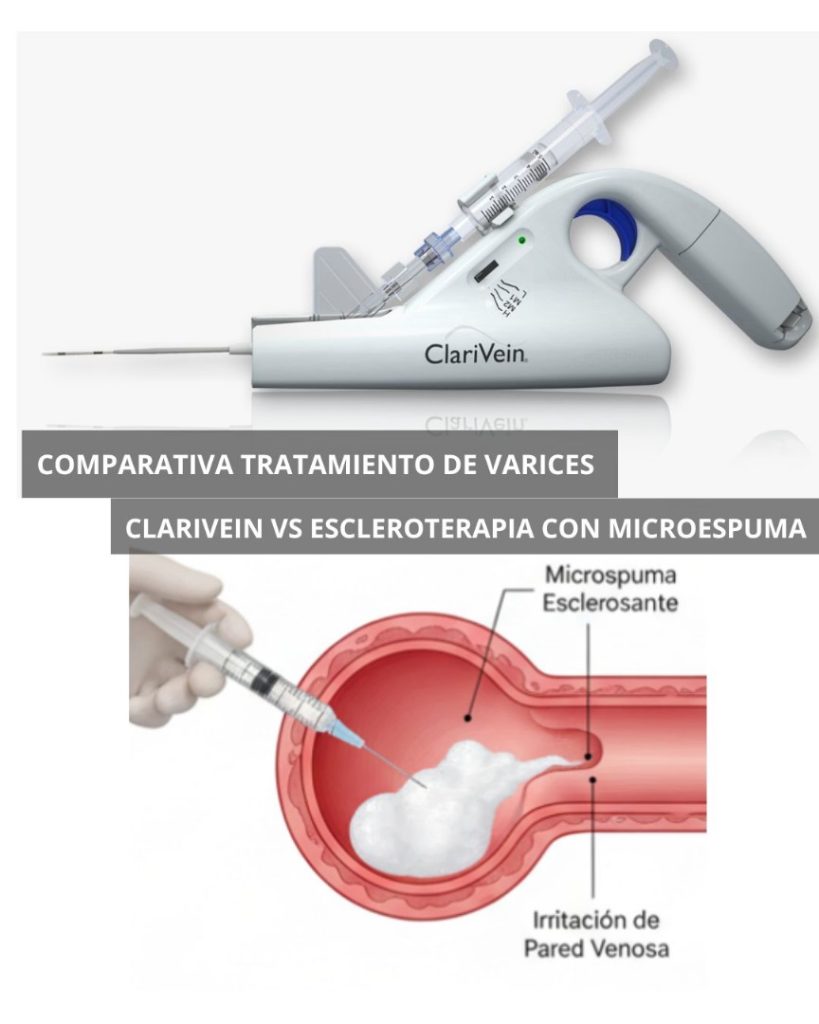 clarivein vs escleroterapia con microespuma