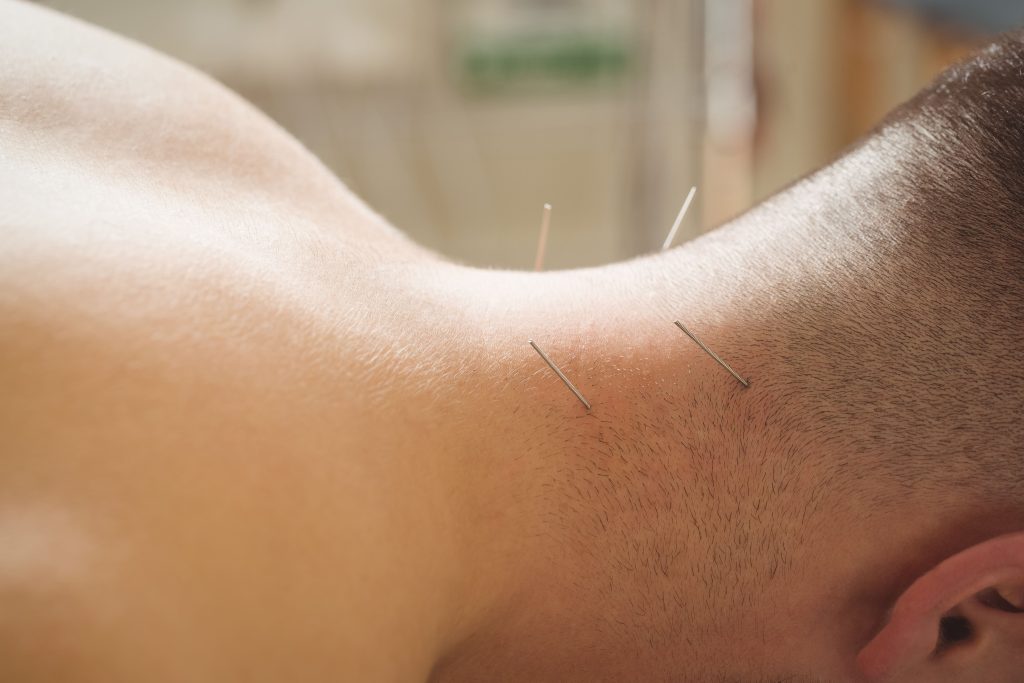 acupuntura cuello