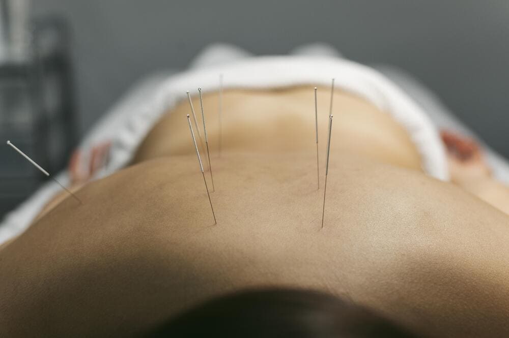 proceso acupuntura cliente