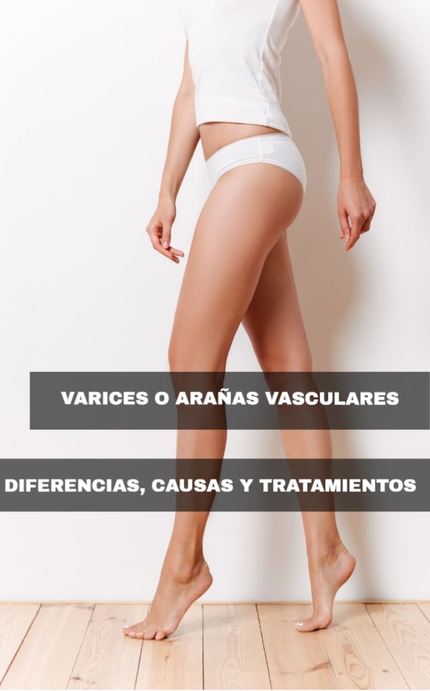 Varices o arañas vasculares